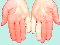 Hand Arm Vibration Syndrome